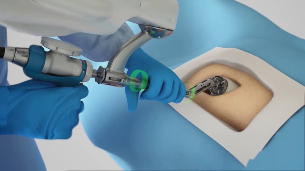 Robotic Hip Replacement